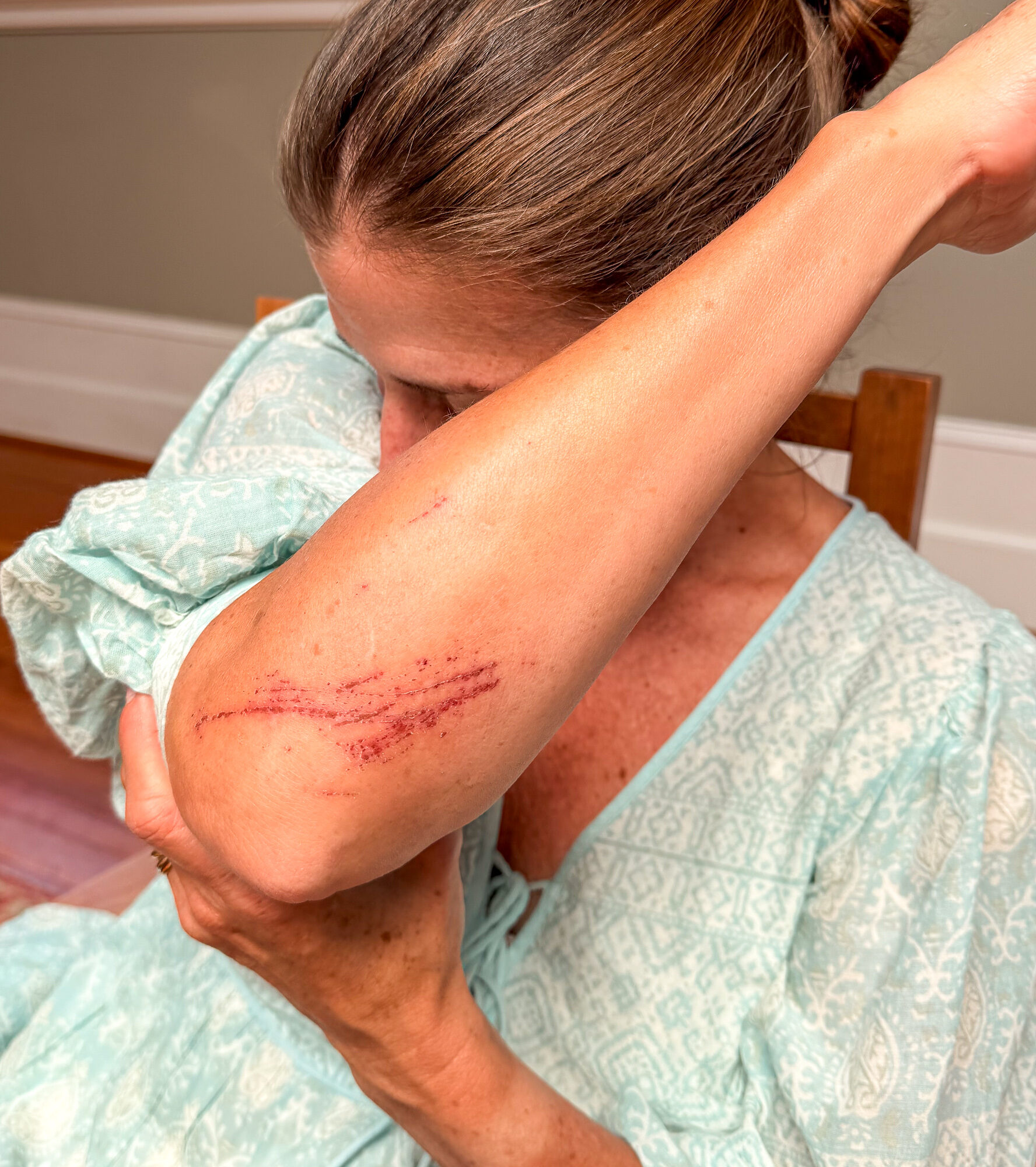 A raw, raspberry-like abrasion on James's right forearm from a fall on the pumice